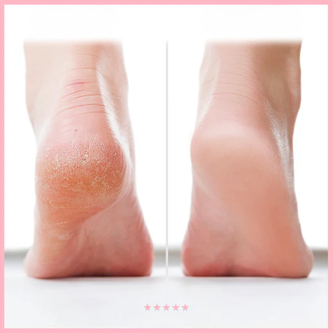 Electric Foot Callus Remover